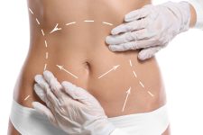 Liposuction